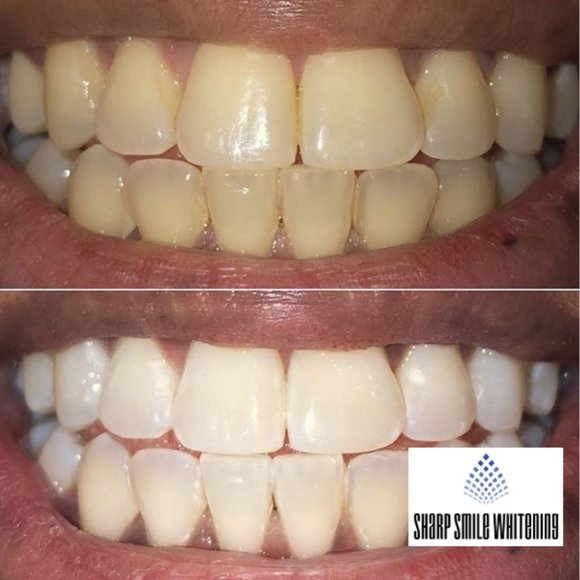 SOLD Teeth Whitening Kit - Picture 8 of 8